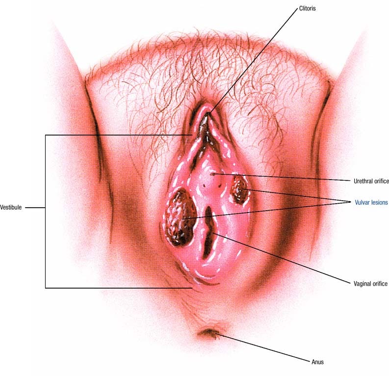 Focus sur le Mélanome vulvaire ou vaginal : Une pathologie qui ...